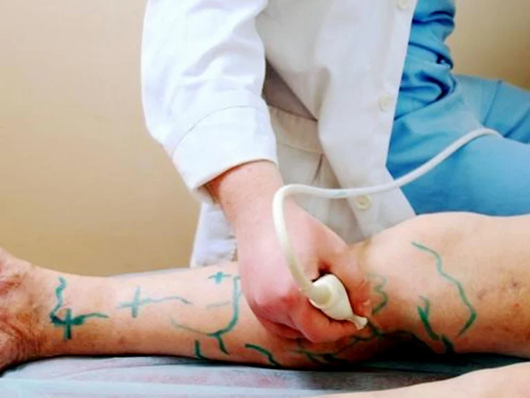 Treatment-varicose-veins-cupping