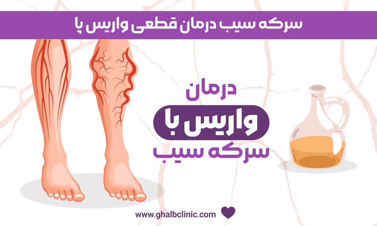 سركه سيب درمان قطعی واریس پا