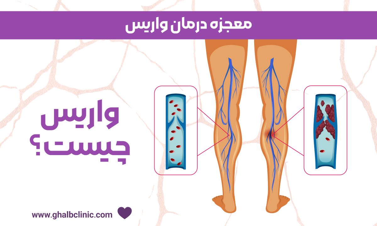 معجزه درمان واریس
