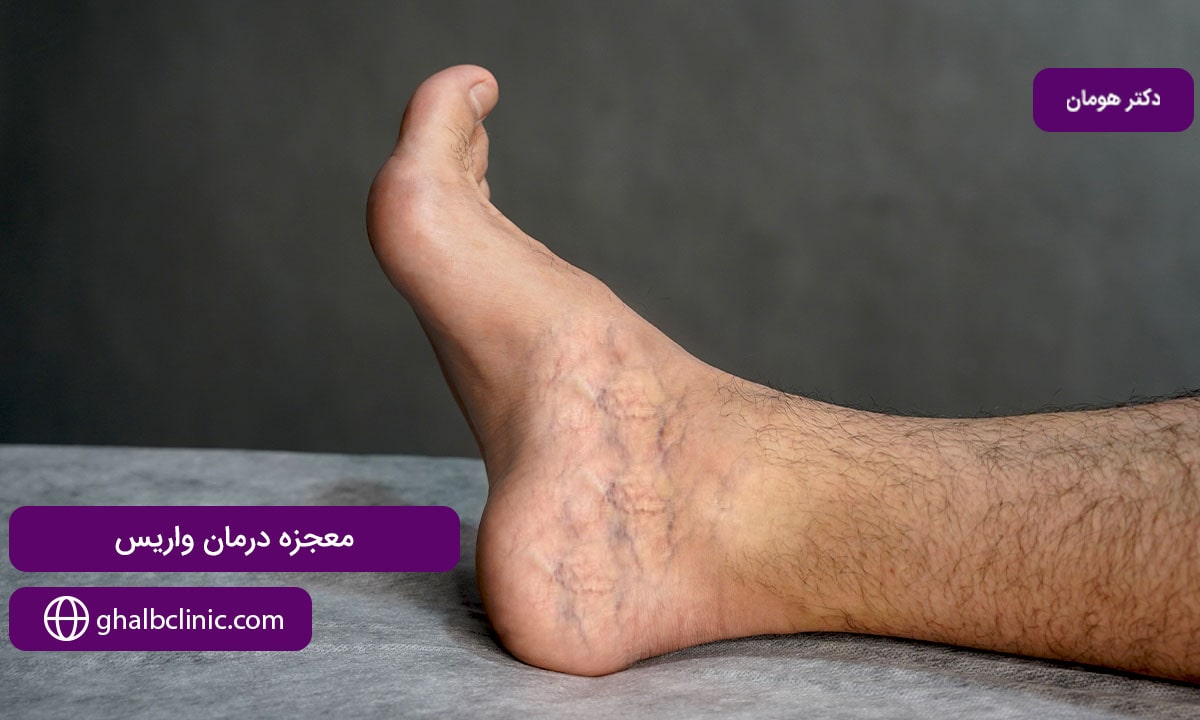 معجزه درمان واریس